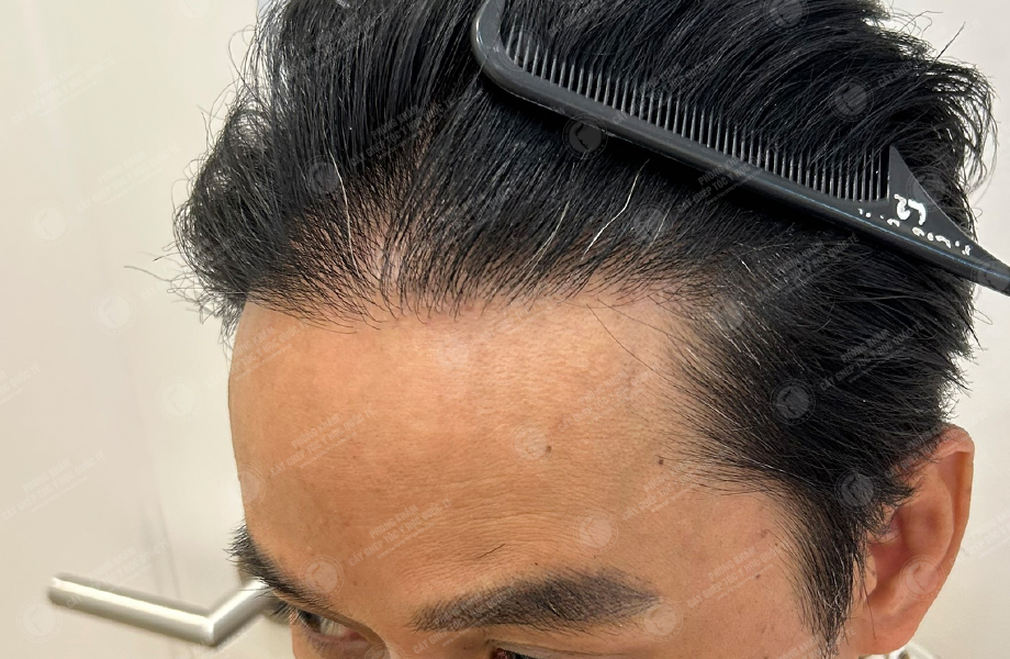 Phùng Tuấn Sơn - Cấy tóc đường chữ M 8