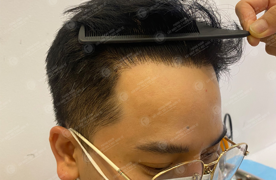 Trần Ngọc Vương - Cấy tóc đường chữ M 8