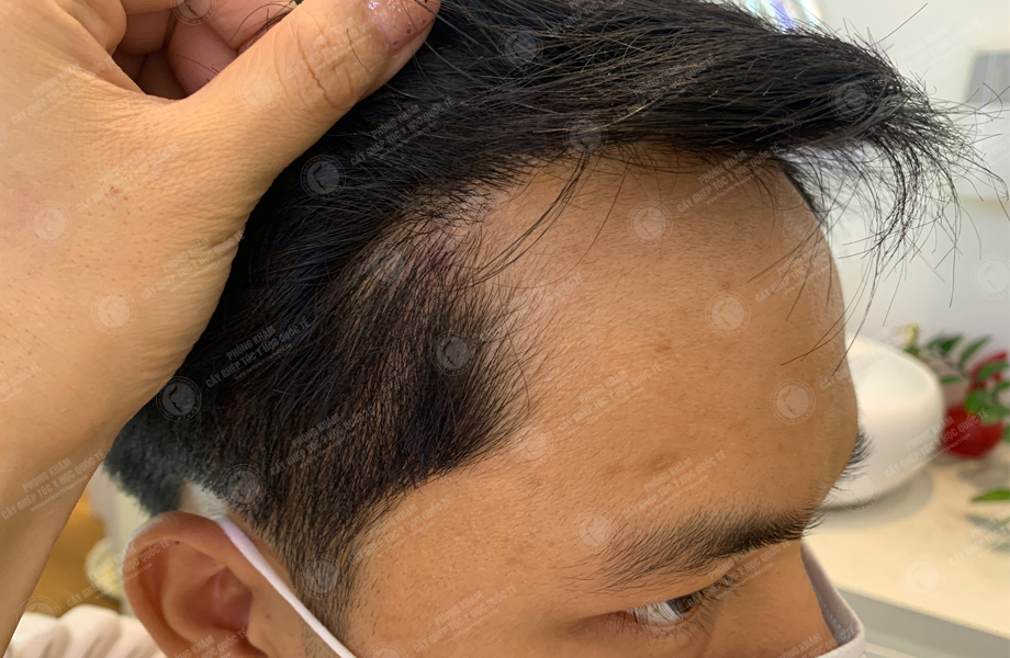 Phạm Quang Hùng - Cấy tóc trên sẹo 9