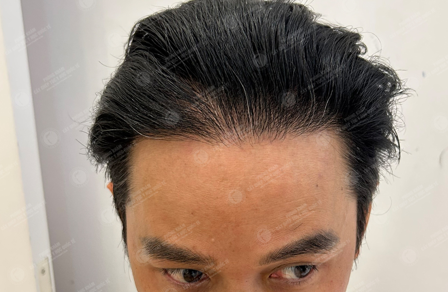 Phùng Tuấn Sơn - Cấy tóc đường chữ M 9