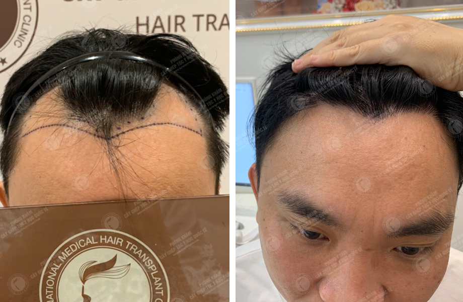  Đinh Nho Huấn - Cấy tóc đường chữ M 1