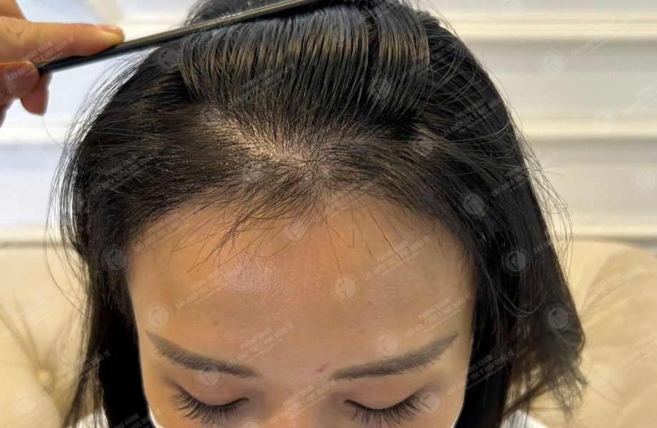 Lê Minh Thư - Cấy tóc đường chữ M 10