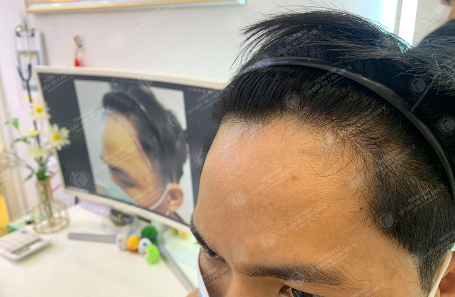 Phạm Quang Hùng - Cấy tóc trên sẹo 10