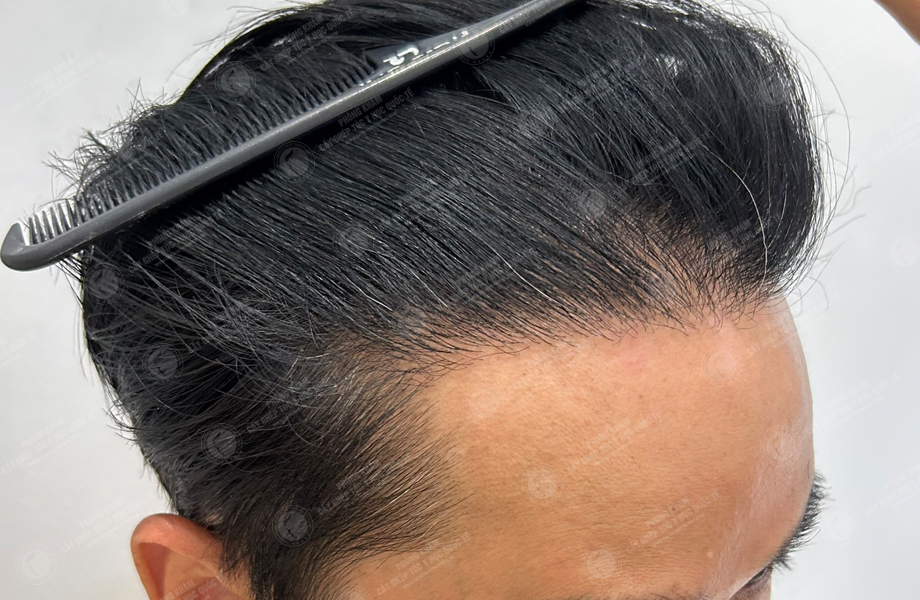 Phùng Tuấn Sơn - Cấy tóc đường chữ M 10