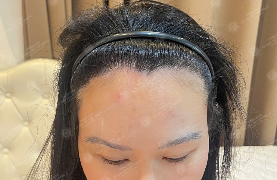 Nguyễn Minh Nguyệt - Cấy tóc đường chữ M 10