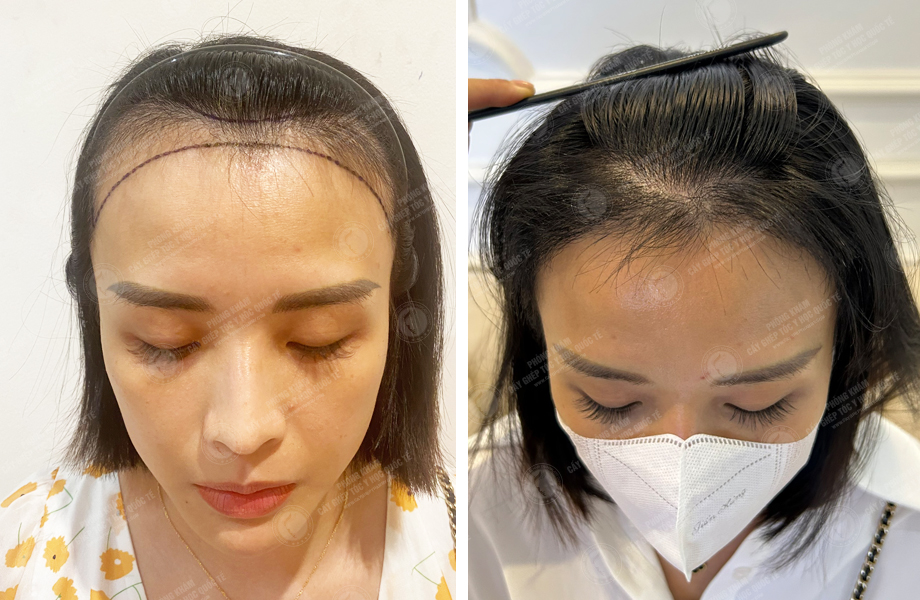  Lê Minh Thư - Cấy tóc đường chữ M 1