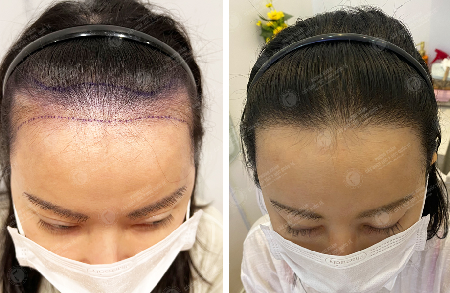  Lê Khánh Thy - Cấy tóc đường chữ M 1