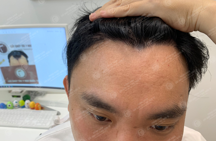 Đinh Nho Huấn - Cấy tóc đường chữ M 9