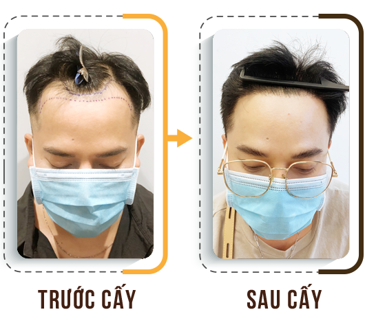 cấy tóc trị hói