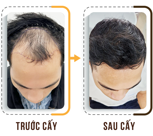 cấy tóc trị hói