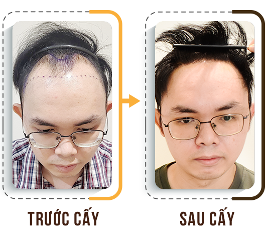 cấy tóc trị hói