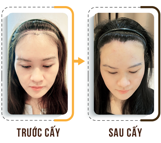 cấy tóc trị hói