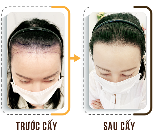 cấy tóc trị hói