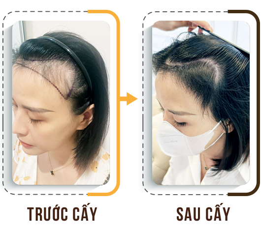 cấy tóc trị hói