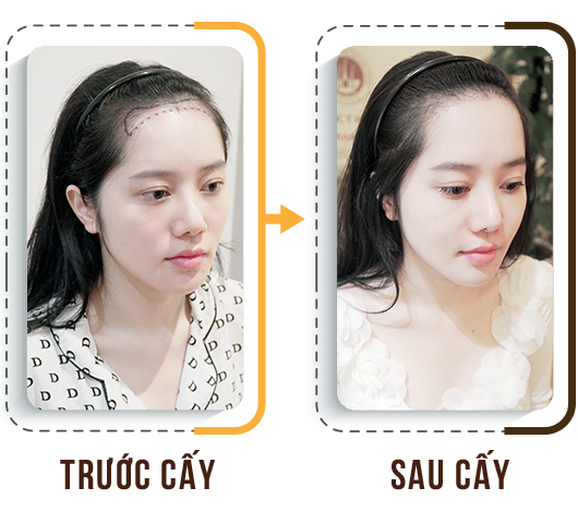 cấy tóc trị hói