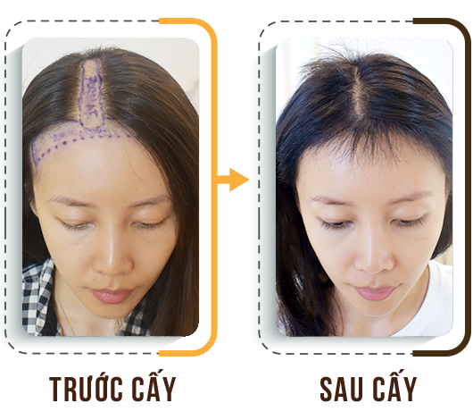 cấy tóc trị hói