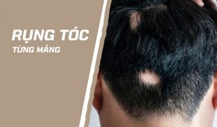 [Bỏ túi]: 10+ Kinh nghiệm chữa rụng tóc từng mảng hiệu quả, an toàn