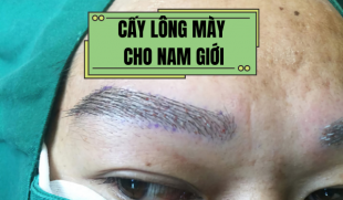Cấy lông mày cho nam giới: Phương pháp hiện đại không thể bỏ qua