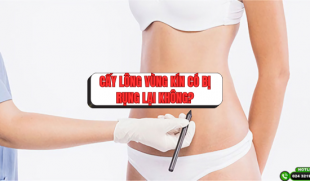 Cấy lông vùng kín có bị rụng lại không? Giải đáp từ Chuyên gia