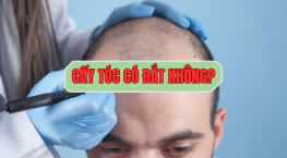 Giải mã cấy tóc có đắt không: Đắt hay rẻ phụ thuộc vào điều gì?