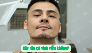 Cấy râu có vĩnh viễn không – Đọc ngay nếu bạn muốn râu đẹp lâu dài