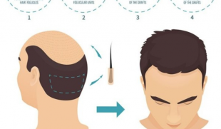 Cấy tóc FUE: Những điều cần biết trước khi thực hiện