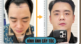 Hình ảnh cấy tóc thực tế: Trước và sau khi phục hồi mái tóc