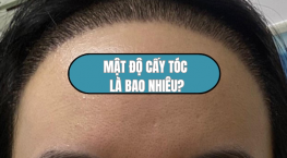 Mật độ cấy tóc bao nhiêu là lý tưởng? Giải đáp từ chuyên gia