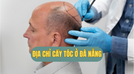 Bật mí địa chỉ cấy tóc ở Đà Nẵng – An toàn, hiệu quả, thẩm mỹ