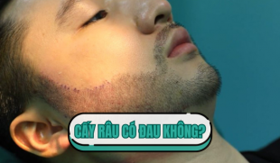 Thực hư chuyện cấy râu có đau không? Sự thật bạn cần biết