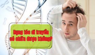 Rụng tóc di truyền có chữa được không? Chuyên gia giải đáp