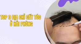 Top 3 địa chỉ cấy tóc ở Hải Phòng uy tín nhất hiện nay