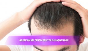 Giải đáp thắc mắc: Cấy tóc ở đâu uy tín tại Hà Nội và TPHCM?