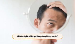 Giải đáp: Cấy tóc có hiệu quả không và duy trì được bao lâu?