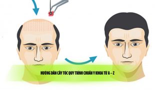 Hướng dẫn cấy tóc quy trình chuẩn y khoa từ A – Z