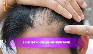 7 cấp độ rụng tóc – Hiểu rõ để có hướng điều trị đúng