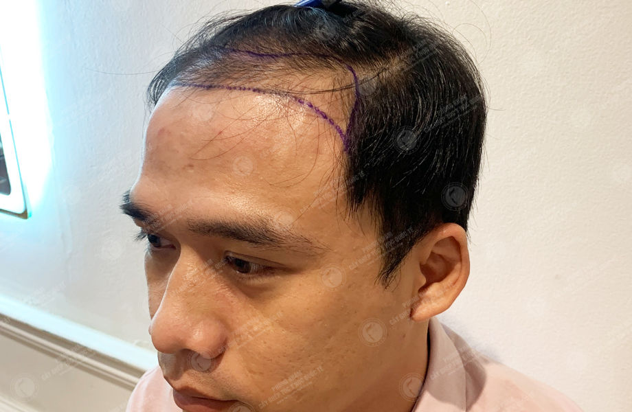 Ngô Huy Hùng - Cấy tóc đường chữ M 2