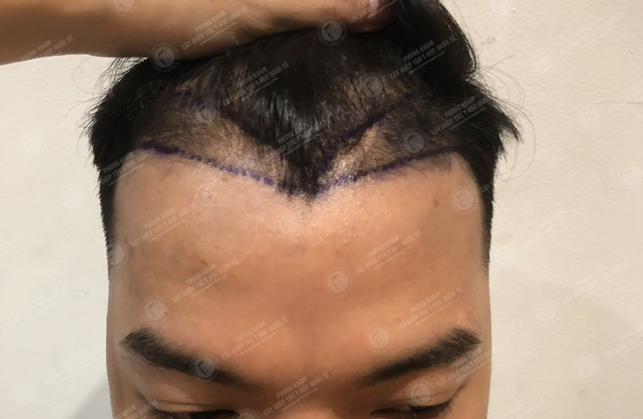 Trương Thiên Thanh - Cấy tóc đường chữ M 2