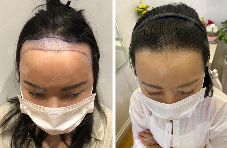  Nguyễn Thùy Linh - Cấy tóc tự thân 1