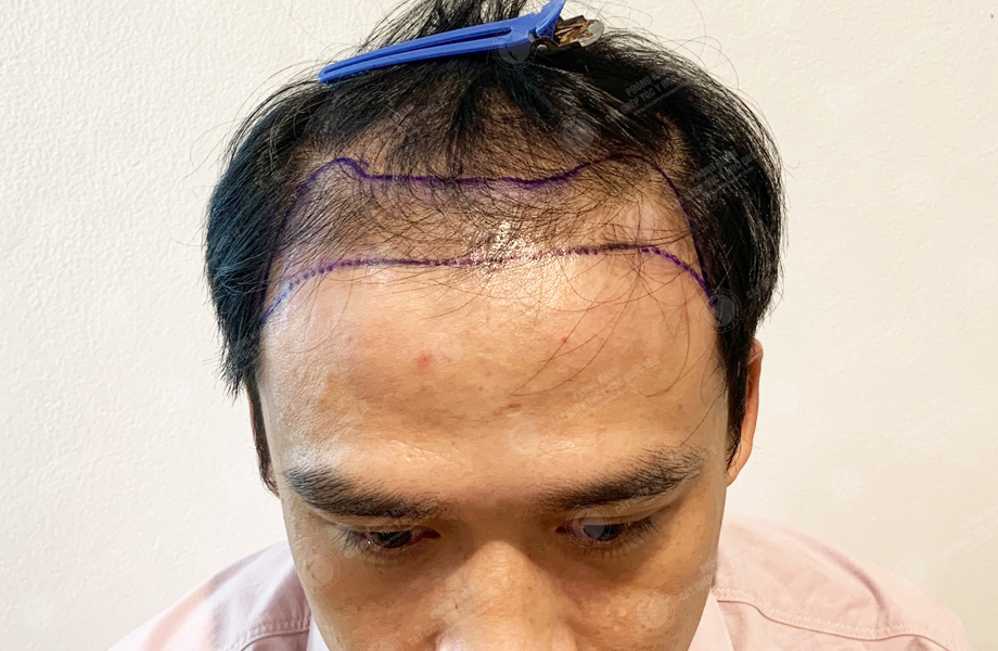 Ngô Huy Hùng - Cấy tóc đường chữ M 3
