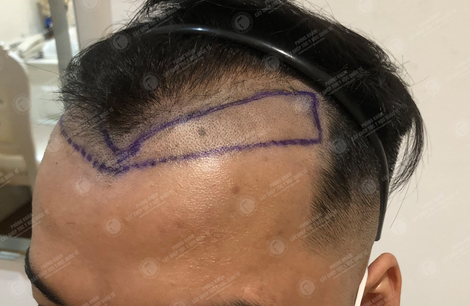 Trương Thiên Thanh - Cấy tóc đường chữ M 4