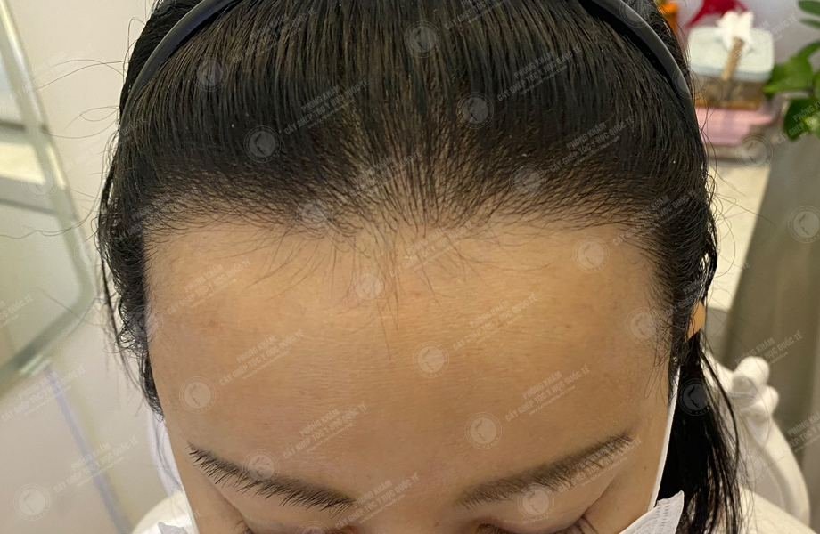 Nguyễn Thùy Linh - Cấy tóc đường chữ M 6