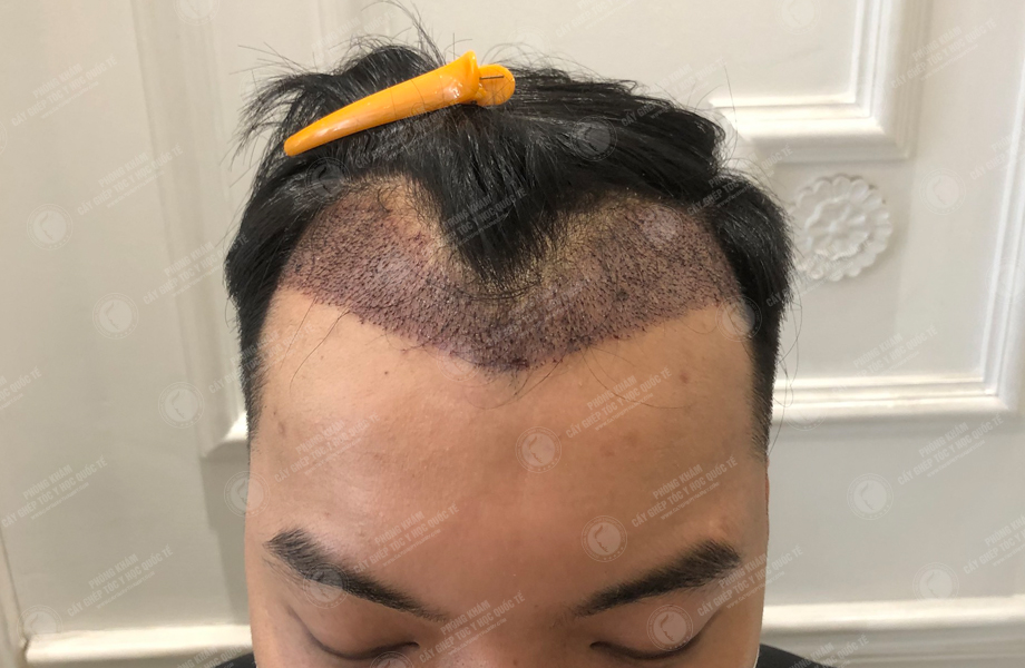 Trương Thiên Thanh - Cấy tóc đường chữ M 6