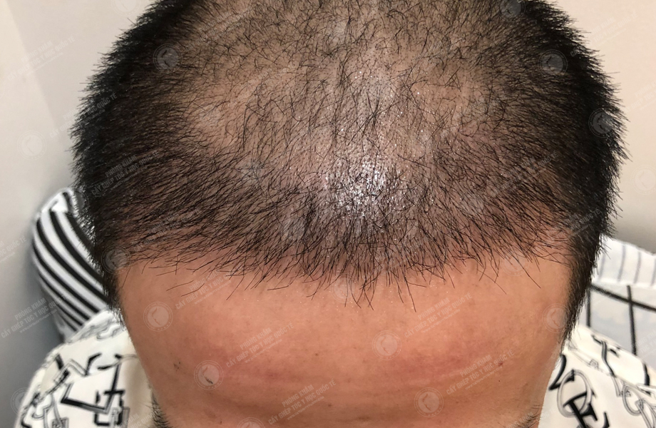 Ngô Huy Hùng - Cấy tóc đường chữ M 7
