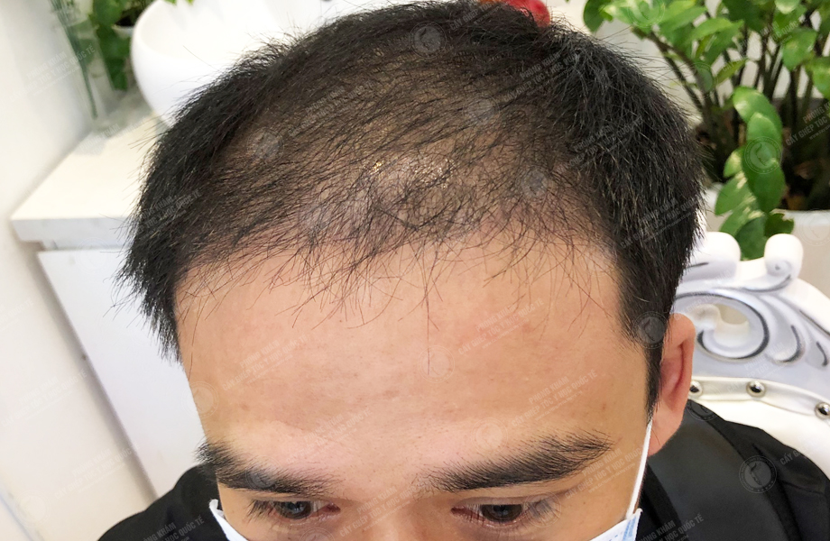 Ngô Huy Hùng - Cấy tóc đường chữ M 8
