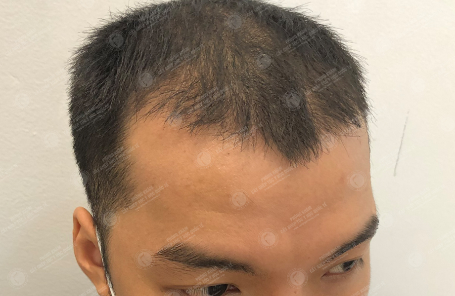 Trương Thiên Thanh - Cấy tóc đường chữ M 8