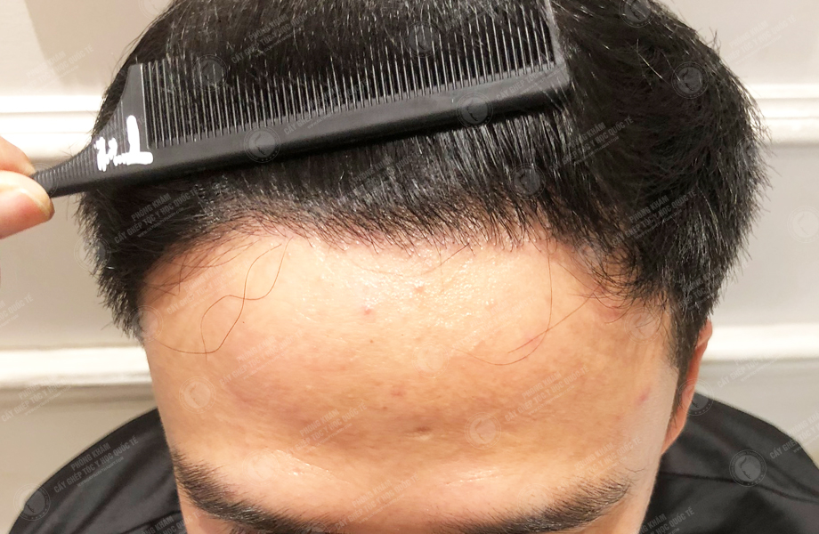 Ngô Huy Hùng - Cấy tóc đường chữ M 9