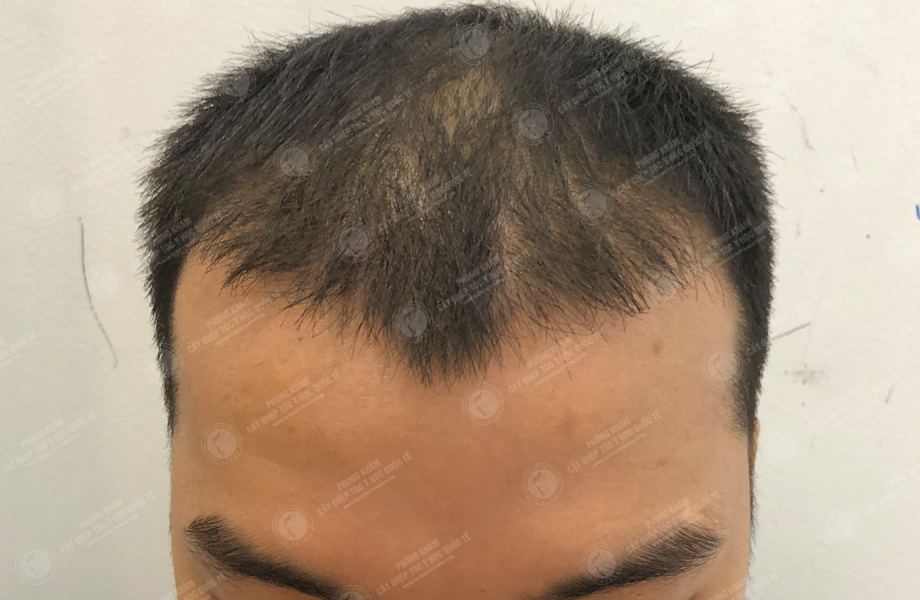 Trương Thiên Thanh - Cấy tóc đường chữ M 9
