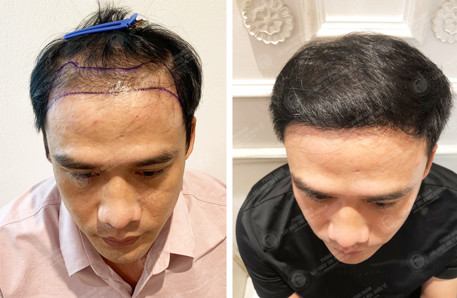  Ngô Huy Hùng - Cấy tóc đường chữ M 1