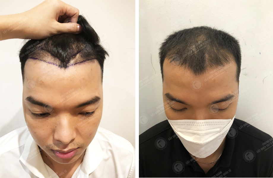  Trương Thiên Thanh - Cấy tóc đường chữ M 1